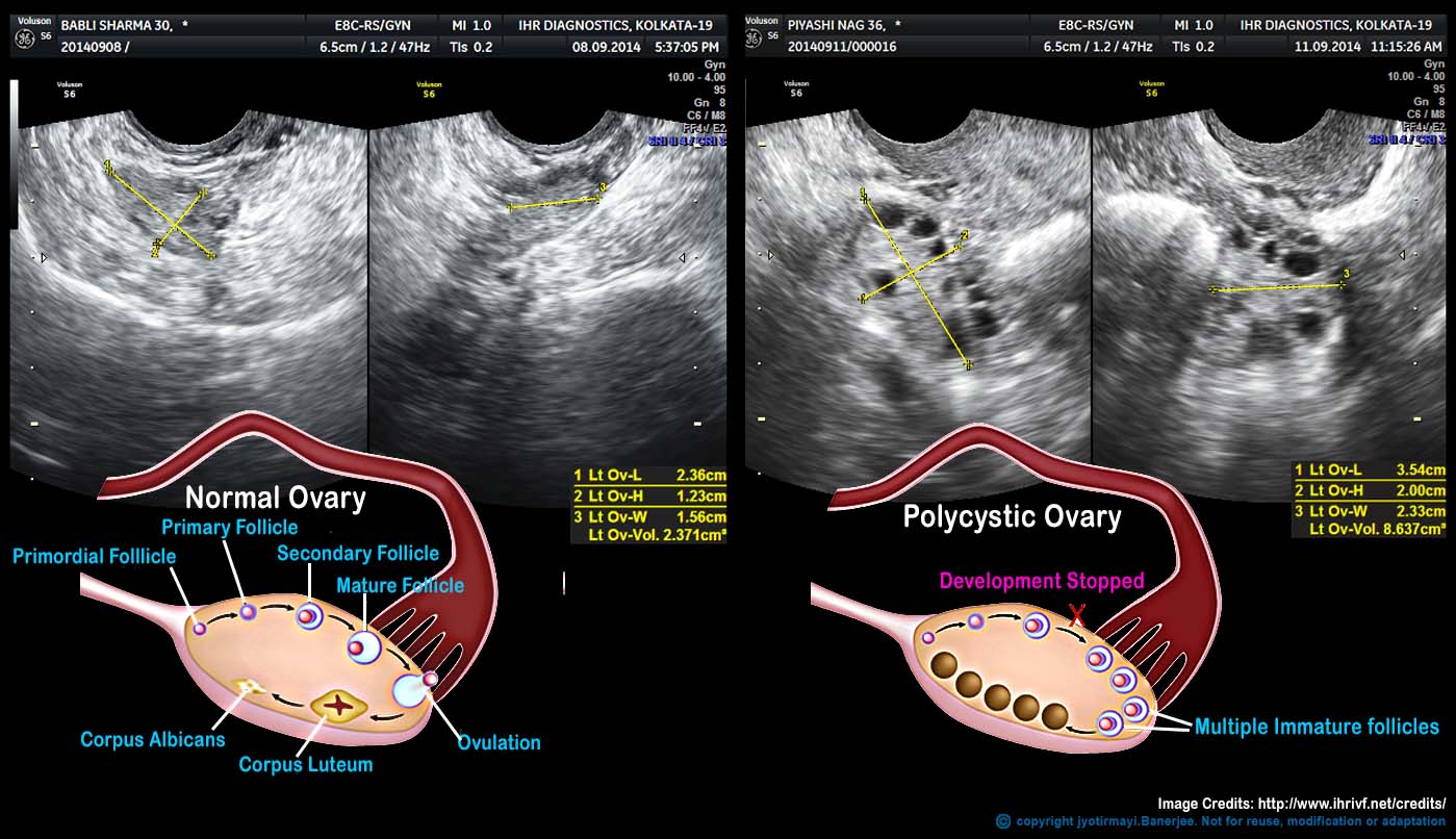 What Are Polycystic Ovarian Syndrome Pcos Is