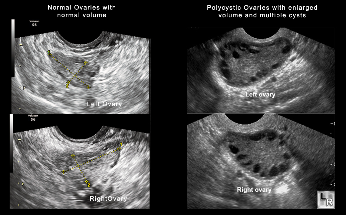 Infertility Treatment in Kolkata, Polycystic Ovary Syndrome