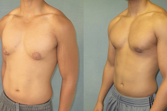 Gynecomastia