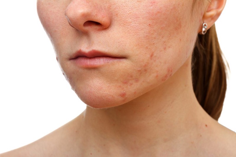 acne-skin inflammation